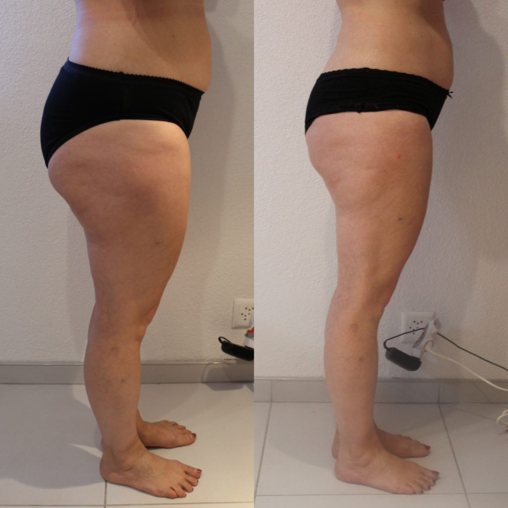 Maderotherapie AcuMax Cellulite Fettpolster Vorher Nacher worldofwellness z